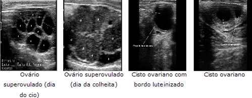 candidose wikipédia